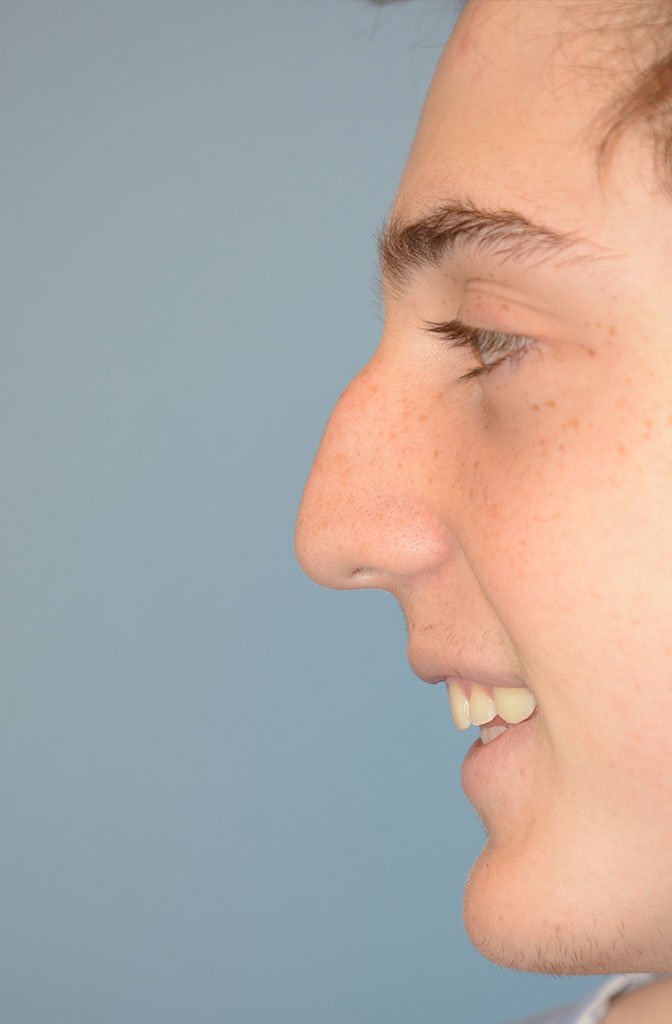 Benefits And Efficacy Of Sinus Surgery Bring Lasting Relief