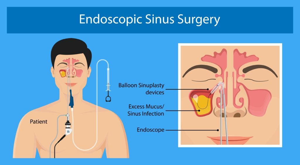 Understanding Sinus Surgery & Indications for Better Health Outcomes